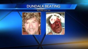 Dundalk Man Beaten 2015